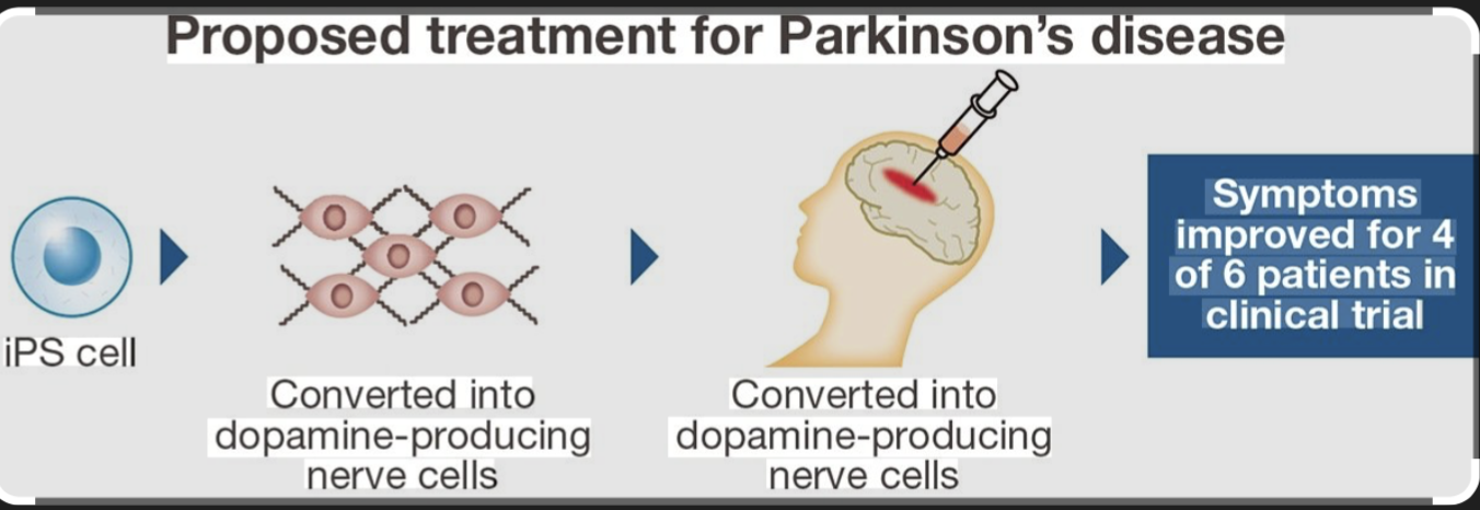 22026/02 MHLW subcommittee approves iPS derived Qualips’ cardiomyocyte cell sheets and Sumitomo Pharma’s dopaminergic neuronal progenitor cells